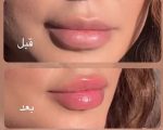 حجم دهنده لب آمپولی کیس بیوتی - تصویر 2