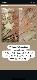 اسکراب کف سر - تصویر 2