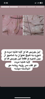 اسکراب کف سر - تصویر 3